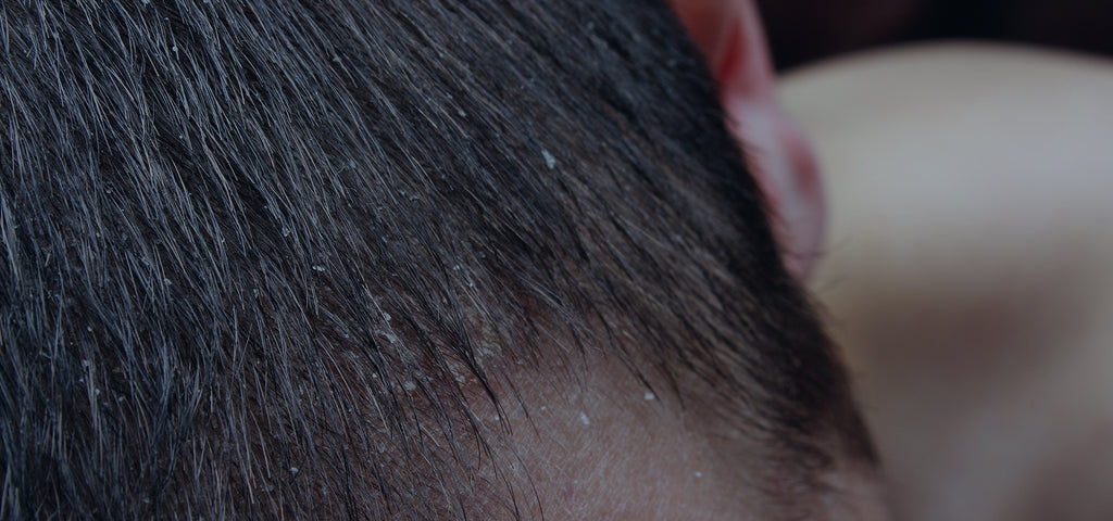 Understanding Dandruff: Causes and Treatments - Oxford Biolabs
